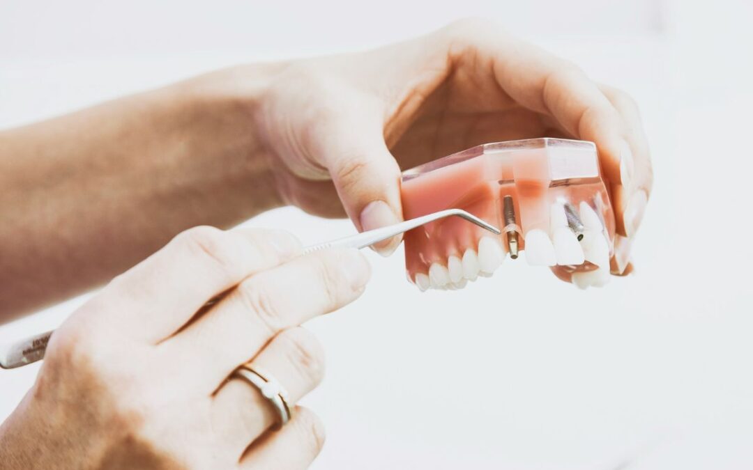 Implantes dentales: volver a sonreír con confianza